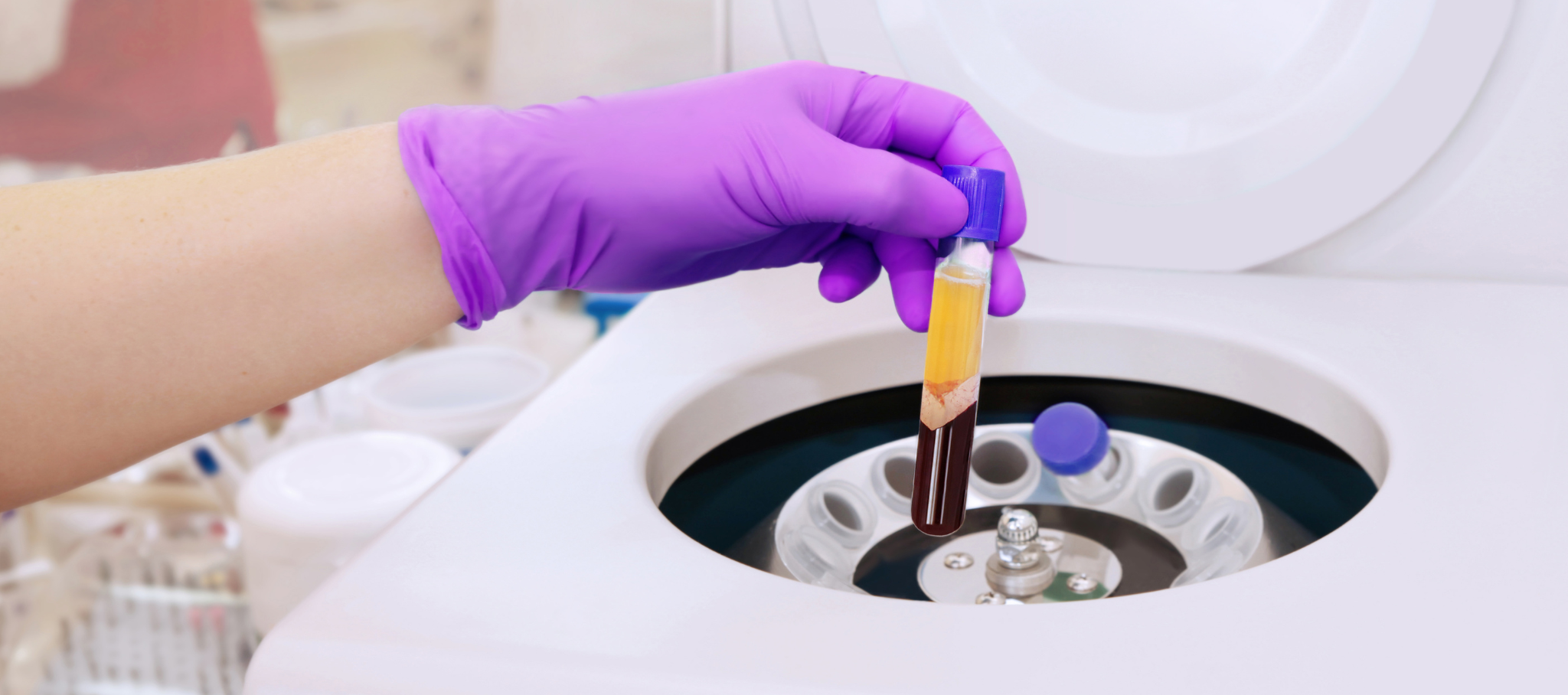 Avaya Aesthetics | Unlocking the Potential of Platelet - Rich - Plasma (PRP) Injections: A Comprehensive Q & A Guide
